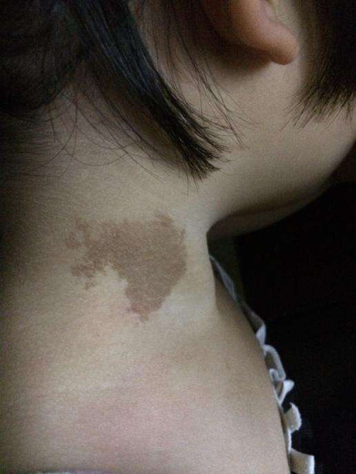 泉州德化县哪里治胎记较好