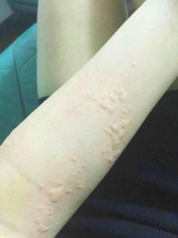 德化县治荨麻疹哪所门诊不错
