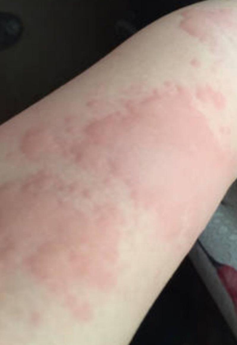石狮市专业去看荨麻疹的皮肤科在哪里