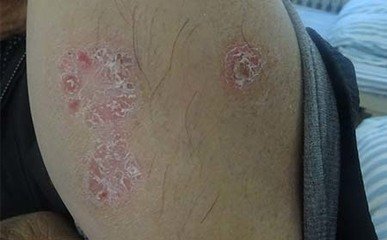 丰泽区银屑病治疗的医院