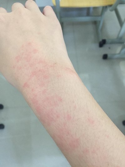 南安市治皮炎的医院怎么样