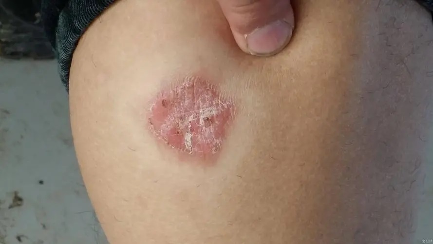 牛皮癣都会引起哪些症状